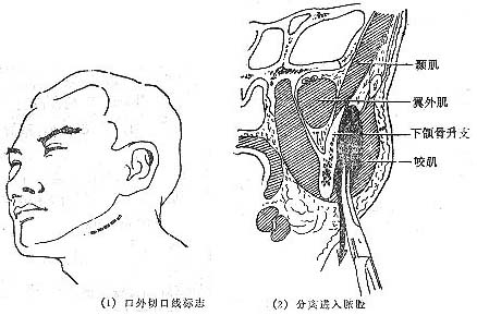 图1  咬肌间隙脓肿口外切开引流术【病因学】咬肌间隙(masseteric
