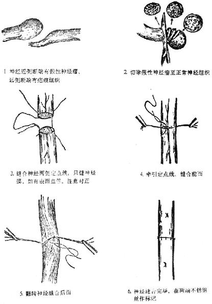 图3-154 神经外膜缝合示意图