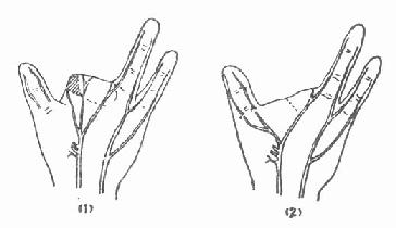 桡神经损伤的典型症状 0390749114.jpg