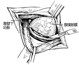 1-1 环形切开疝囊基底部下缘腹横筋膜