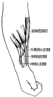 ⑺转移并缝合桡侧屈腕肌腱至外展拇长肌和伸拇长短肌腱上