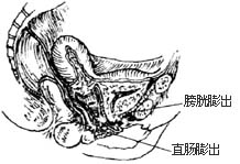 图2 膀胱,阴道膨出