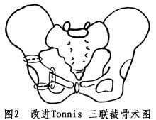 新式三联截骨术治疗髋关节半脱位