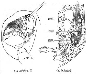 龈颊沟示意图图片