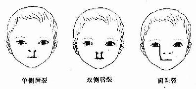 唇裂 唇裂(cleft      lip)是最常 一种颜面畸形,多因上颌隆起与同侧