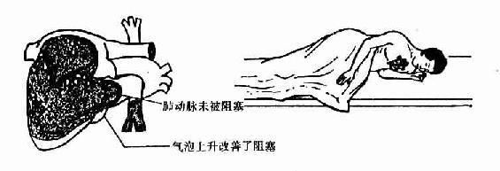 (2)立即使病人左侧卧位和头低足高位,此位置在吸气时可增加胸内压力